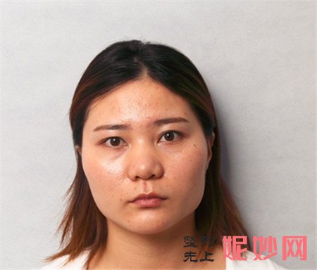 到上海时光找何晋龙医生做的V-LINE瓜子脸手术怎么样？真人案例分享