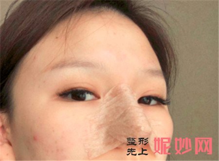 湘雅三医院烧伤整形科找王少华做的肋软骨隆鼻，不用羡慕别人的高鼻梁