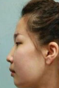 鼻整形专家葛海辉12月在武汉中翰整形医院量身打造鼻综合整形