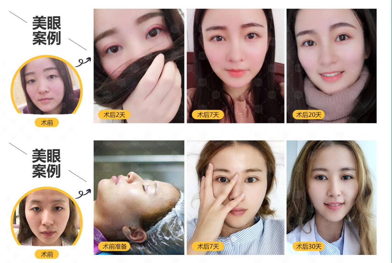 南宁韩星缔造美眼新标准_双眼皮手术只美怎么够?还要更快恢复