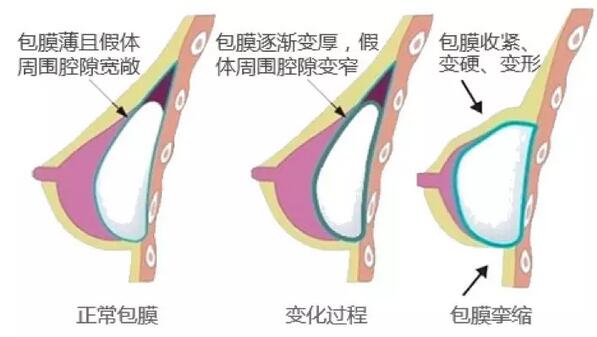 南宁贺尔美详解假体隆胸手术后，乳房严重变形、疼痛的原因