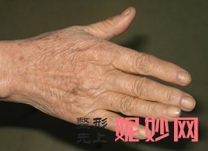 北京禾美嘉任学会自体脂肪填充手好么?任学会脂肪丰手真人案例效果_恢复过程图