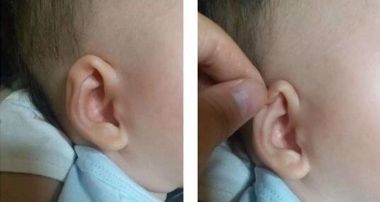 唐山妇幼保健院无创矫正新生儿耳廓形态畸形，效果好值得信赖