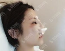 中南大学湘雅医院整形美容科鼻综合案例分享，你们觉的我的恢复如何，有没有惊呆住！