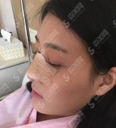 榆林市第二医院整形美容外科隆鼻做的如何？小仙女鼻综合案例术后反馈