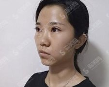 山东省立医院整形外科隆鼻技术可以吗？附鼻综合案例＋价格表出炉！