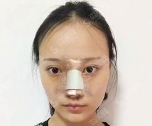 扬州苏北医院整形美容科价格表，膨体隆鼻恢复详情及图片对比
