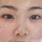 济南省立医院美容科祛斑价格表,祛斑案例及术后效果