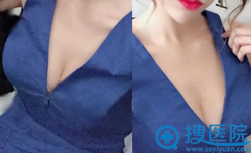 选择润美玉之光朱金成隆胸20天后