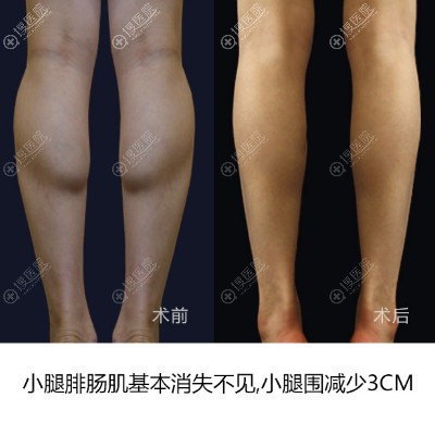 上海丽质卢九宁吸脂瘦腿案例