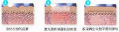颈部皮肤松弛有什么方法可