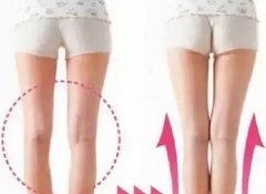 O型腿怎么办？O型腿矫正效
