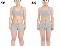 吸脂失败的表现是什么?