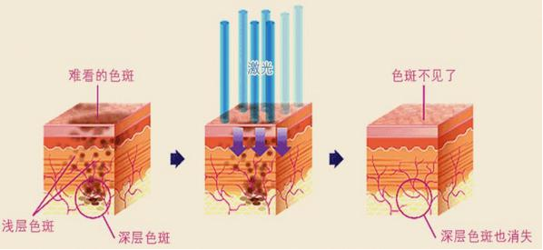 激光祛斑有没有副作用?能消灭顽固斑块吗?