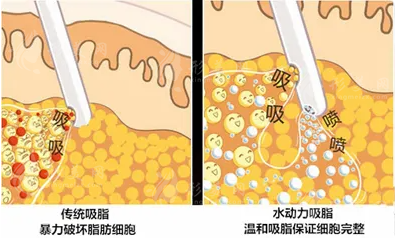 水动力吸脂手术效果怎么样?