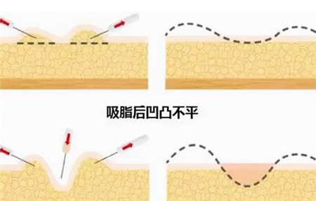 水动力吸脂有什么优点?