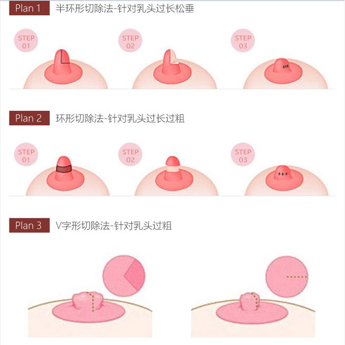 乳头缩小会影响母乳喂养吗？乳头缩小手术的特点是什么?