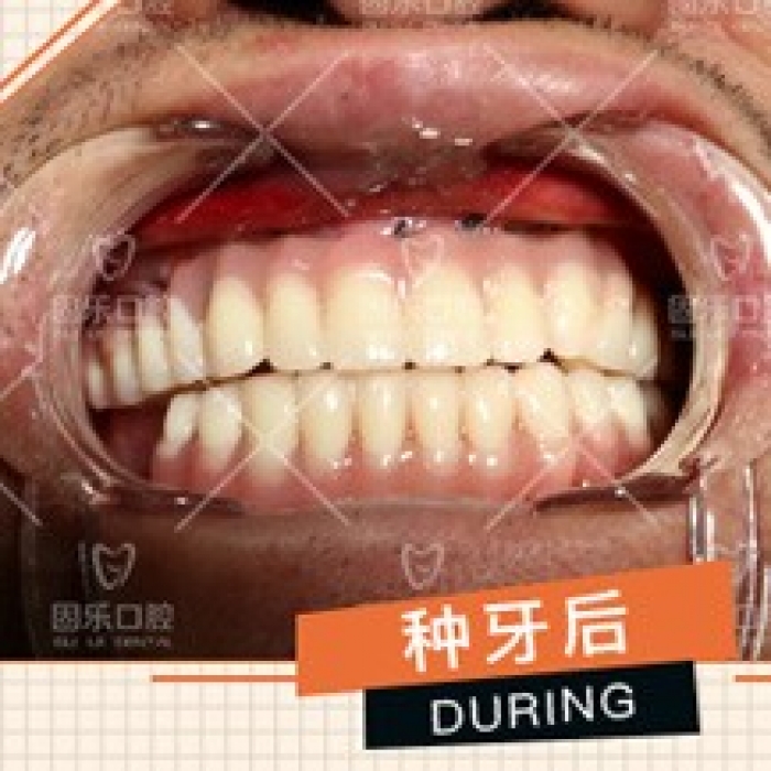 郑州固乐口腔医院全口种植牙案例！_整形真实案例日记