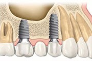 人工牙根能用一辈子吗？种植牙万一坏了怎么办？