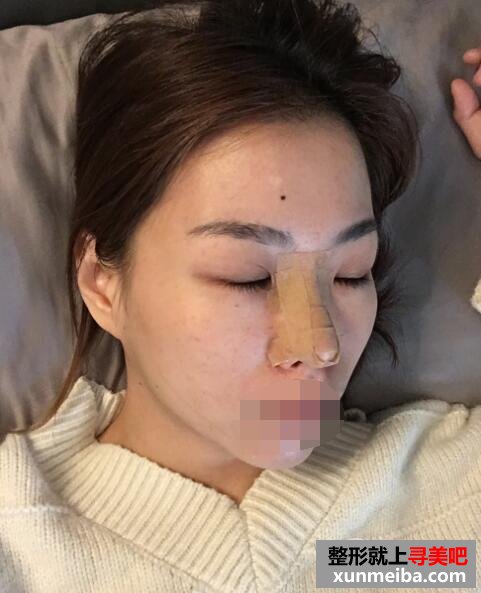 厦门思明欧菲医疗美容门诊部整形案例术后一周