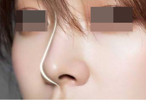 假体隆鼻后要做哪些护理